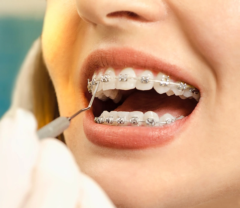 Modern metal braces close-up at VIVA Orthodontics in Bountiful, UT